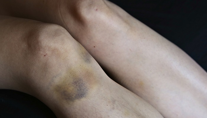MPCE recomenda que Polícia Civil de Boa Viagem e Madalena realize auto de constatação provisório de lesão corporal em casos de violência doméstica 